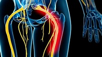 Sciatica Symptoms and Diagnosis