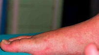 What Does Sun Allergy Rash Look Like? See These Pictures