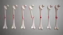 Fractures: Types, Symptoms, Causes and Treatment - Scientific Animations