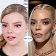 Anya Taylor-Joy Before and After Plastic Surgery