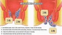 痔瘡甚麼情況下需要做手術? 香港痔瘡中心 查詢:31163836 - YouTube
