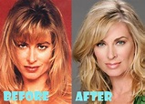 Eileen Davidson Plastic Surgery Before and After Picture - Lovely Surgery