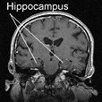 Technology and Techniques in Radiology: Hippocampus MRI