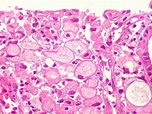 Carcinoma de Células em Anel de Sinete