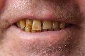 How Do You Know If You Have Bad Teeth? How To FIX It! » Top Cosmetic ...