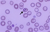 Babesia – Cells and Smears
