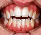ORTODONCIA : Tratamiento de mordida abierta dental con deglución atípica