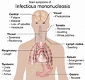 Infectious mononucleosis - Wikipedia