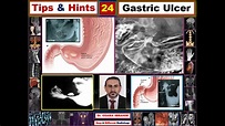 Benign vs malignant gastric ulcers (Tips & Hints 24) Hampton's sign vs ...