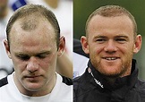 Wayne-Rooney-hair-transplant-before-and-after-1 - Celebrities hair ...