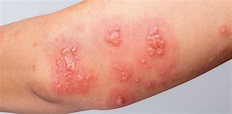 Skin Infections & Treatments | Sagebrush Dermatology