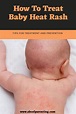 4 Best Ways To Treat Baby Heat Rash | Baby heat rash, Heat rash, Baby rash