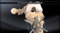 ACL Tibial Fixation using Graft Bolt - YouTube