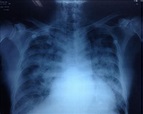 Radiografía de tórax congestión perihiliar e infiltrados algodonosos ...