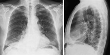 Rayos X del tórax (radiografía de tórax) | Medimagen