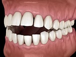 ¿Cómo podemos corregir la mordida abierta? – ZM Centro de Odontología ...