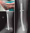 Fracturas osteoporóticas de tobillo: conceptos actuales | FONDOSCIENCE