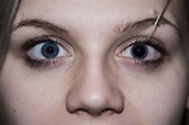 Mydriasis - Dilated Pupil: Causes, Symptoms and Treatment - Scope Heal