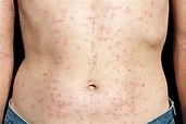 Bacterial Skin Rash: 9 Common Infections