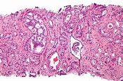 O adenocarcinoma da próstata: descrição, causas, fases, sintomas e ...