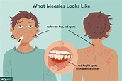 Measles: Overview and More