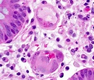 Pathology Outlines - Cytomegalovirus (CMV)