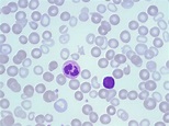 Lymphocytes – A Laboratory Guide to Clinical Hematology