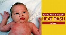 Home Remedies for Heat Rashes in Kids | Prevention and Treatment