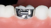 ¿Qué Son Las Bandas De Ortodoncia? | Clínica Dental Ebreclínic