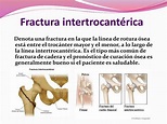 PPT - FRACTURAS DE CADERA PowerPoint Presentation, free download - ID ...