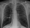 Chronic obstructive pulmonary disease - Wikipedia