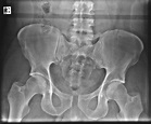 Open book pelvic injury | Image | Radiopaedia.org