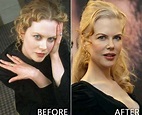 Nicole Kidman rifatta prima e dopo