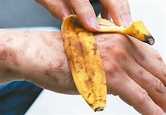 用香蕉皮去斑？ 小心愈抹愈黑 | 皮膚 | 健康百科 | 元氣網