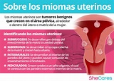 Miomas uterinos | SheCares
