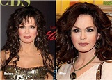Marie Osmond Plastic surgery Before and After Photo 2013-2014