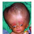 Image of a child with Alexander syndrome with hydrocephalus and ...