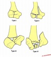 Riseborough and Radin classification of intercondylar fractures of the ...