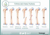 Fracturas óseas: Qué es, causas, síntomas, tratamiento y consejos ...