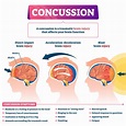 Concussion Lifestyle Changes - JOI Jacksonville Orthopaedic Institute