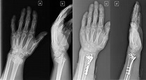 Cureus | Clinical Results of Distal Radius Intraarticular Comminuted ...