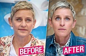 Ellen DeGeneres’ Plastic Surgery Secrets Exposed