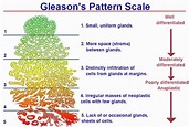 Prostate cancer gleason score