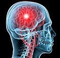 7 Symptoms of Concussions and How to Address Them - IMPACT Physical Therapy