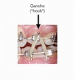 Elásticos en ortodoncia - Luis González Ortodoncia