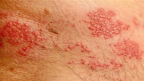 How to treat Groin Rashes: The rash is known to often affect areas of ...
