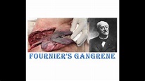 Wound debridement Fournier's gangrene: anaerobic infection of perineum ...