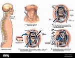 C4-5 and C5-6 Disc Herniations with Discectomies and Spinal Fusion ...