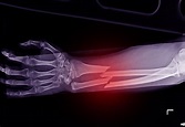 Paris Orthopedics | How To Know If Your Bone Is Broken | Broken Bones ...