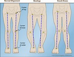 Knock Knees | International Center for Limb Lengthening